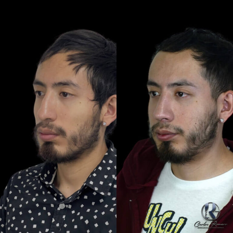 Rinoplastía Cd Juárez - Antes y Después