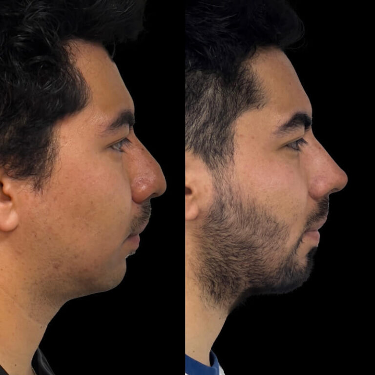 Rinoplastía Cd Juárez - Antes y Después