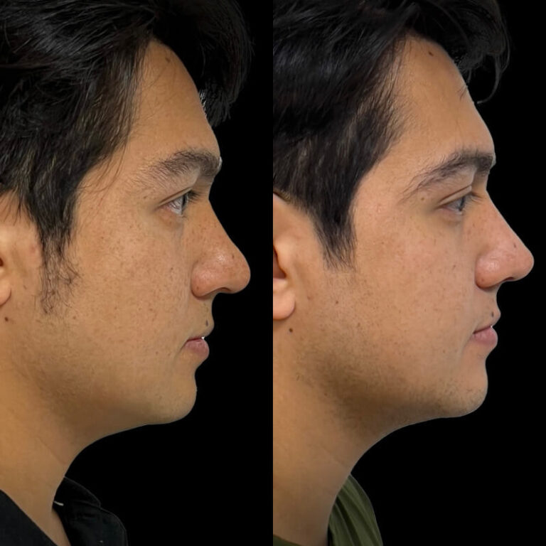 Rinoplastía Cd Juárez - Antes y Después