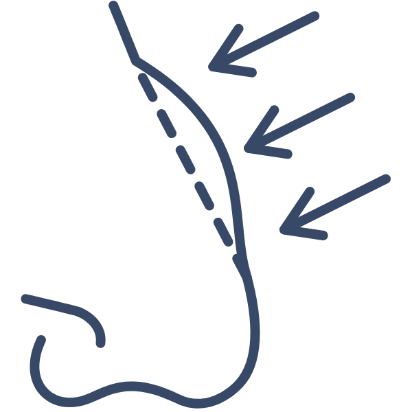 Desviación del tabique nasal